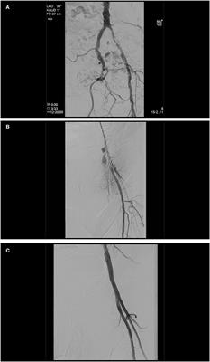 Interventional Treatment of Access Site Complications During Transfemoral TAVI: A Single Center Experience